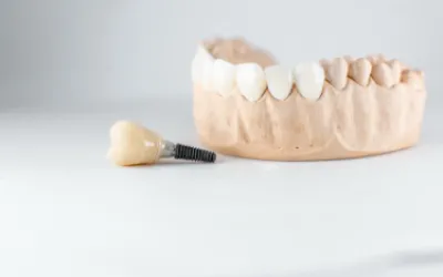 Implantologia dentale a Tirana: procedure, tempi di guarigione e come si decide il costo