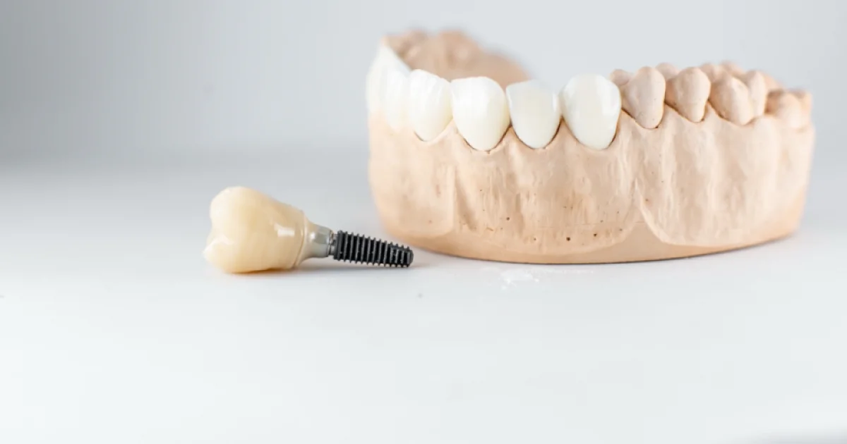 Implantologia dentale a Tirana: procedure, tempi di guarigione e come si decide il costo