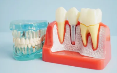 All-on-4 o All-on-6? Come scegliere la riabilitazione giusta per un'arcata completa