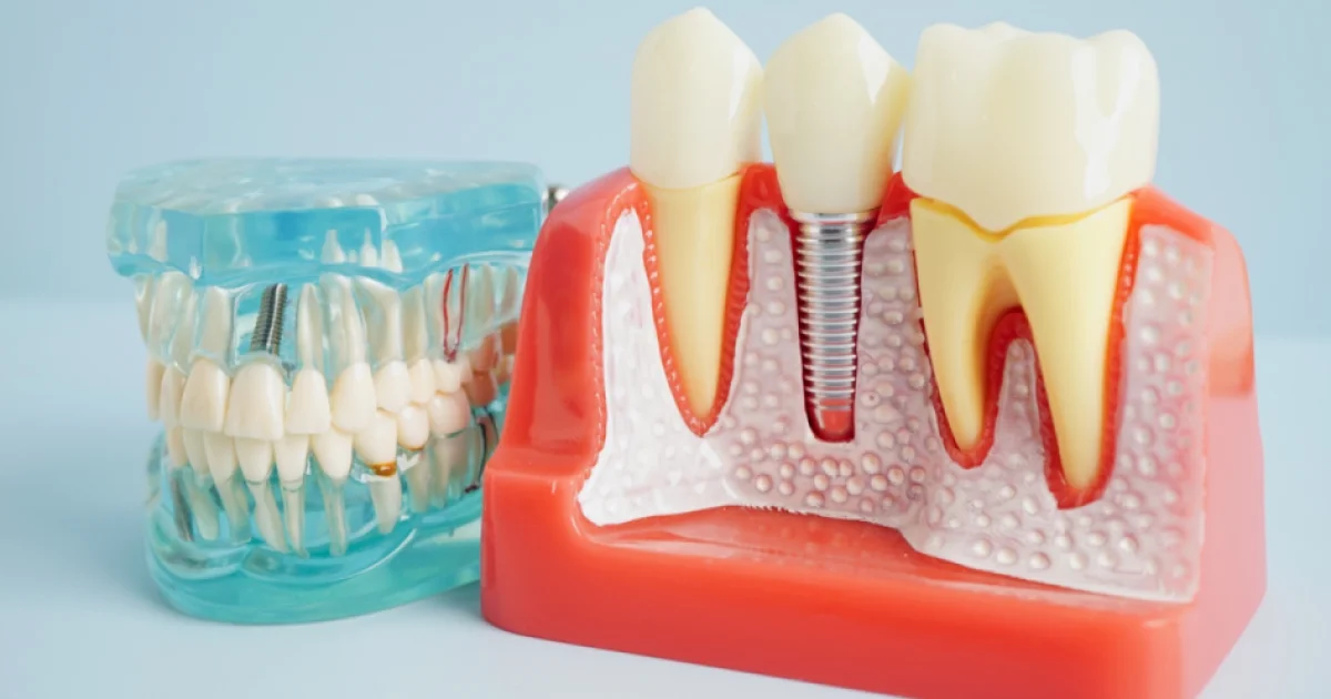 All-on-4 o All-on-6? Come scegliere la riabilitazione giusta per un'arcata completa