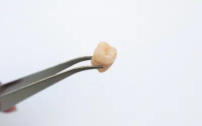 Estrazione del dente del giudizio: guida al recupero