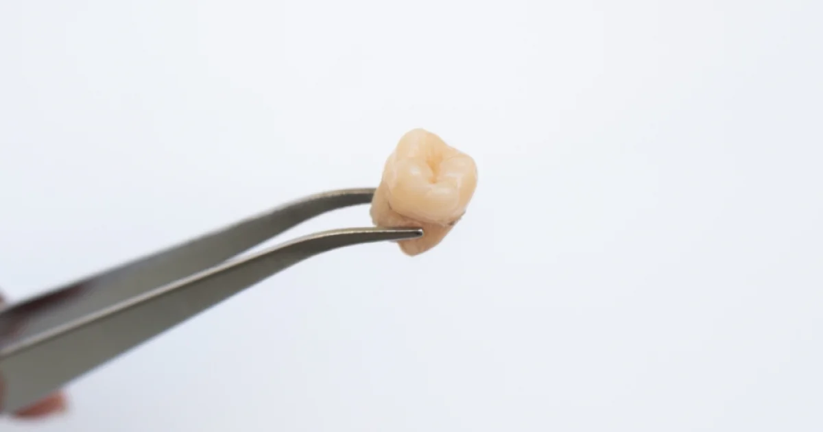Estrazione dente del giudizio: guida completa al recupero