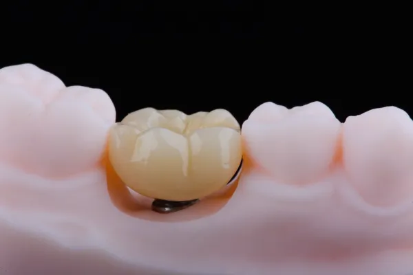 Corona in Zirconia